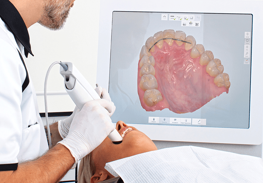 Intraoral Scanner