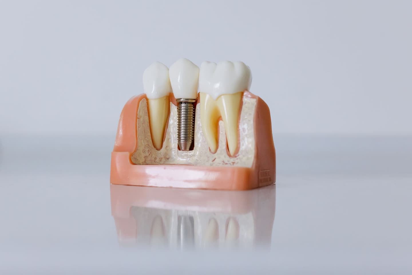 Same-Day Dental Implants in Visakhapatnam: Real Cost, 72-Hour Teeth & What Clinics Won't Tell You About Bone Loss