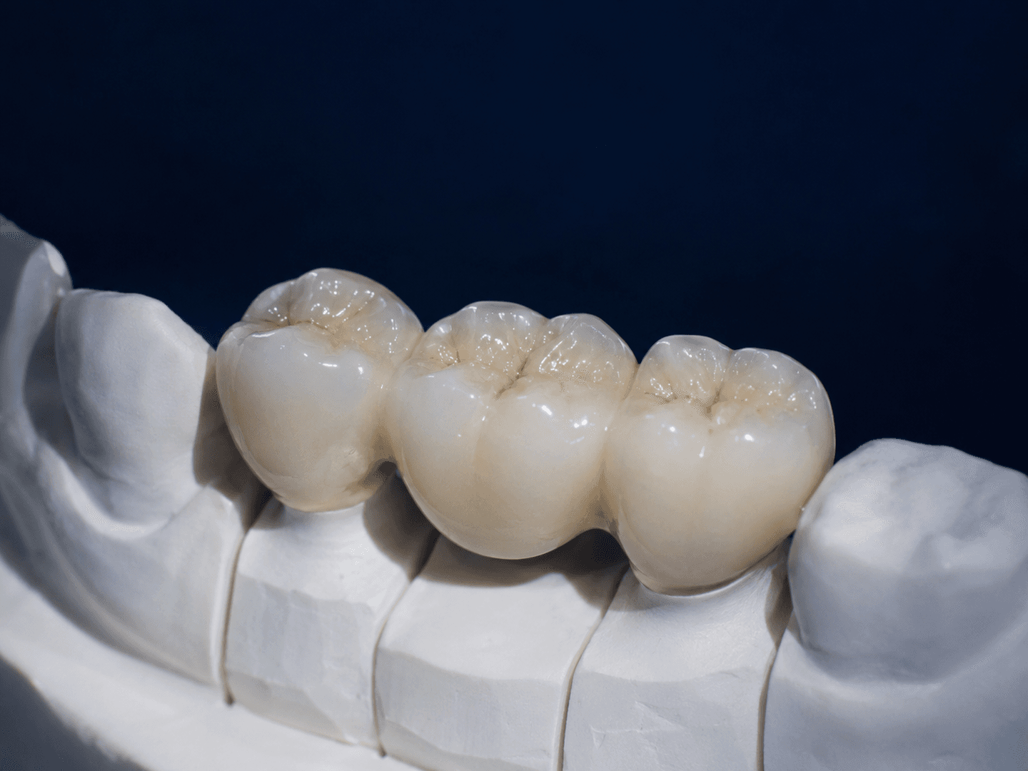 Fixed Prosthesis