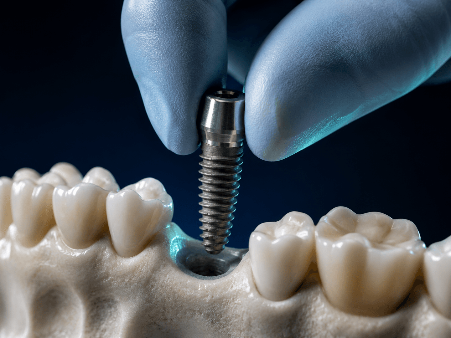 Dental Implants
